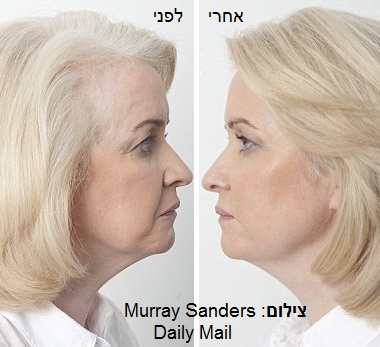 מתיחת פנים ללא ניתוח - לפני ואחרי