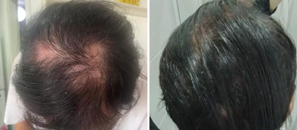 לפני ואחרי - השתלת שיער סינתטי