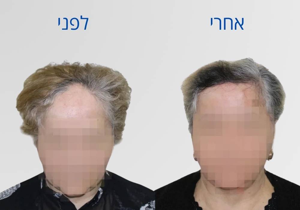 גם נשים יכולות לעבור השתלת שיער